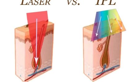 So sánh công nghệ triệt lông Diode Laser và IPL